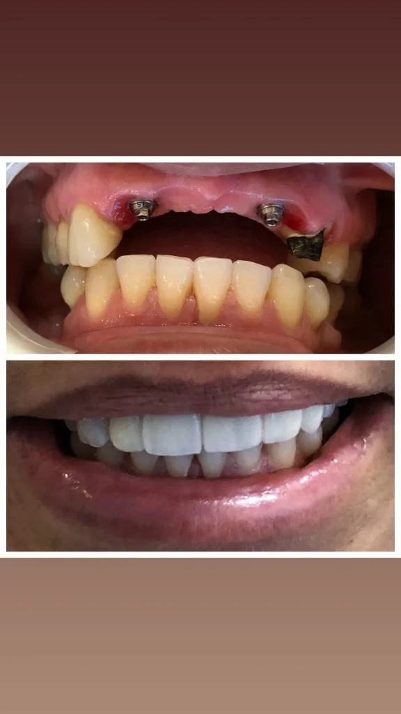 Antes e depois 2